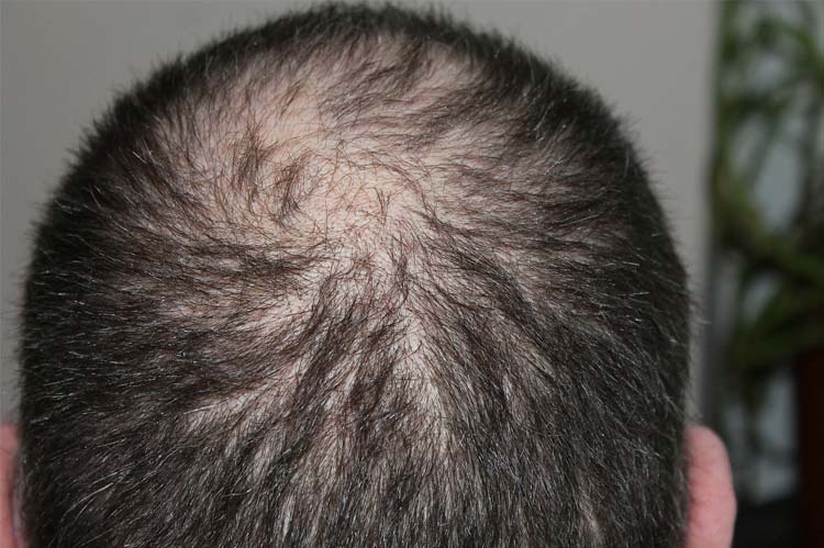 scalp micropigmentation