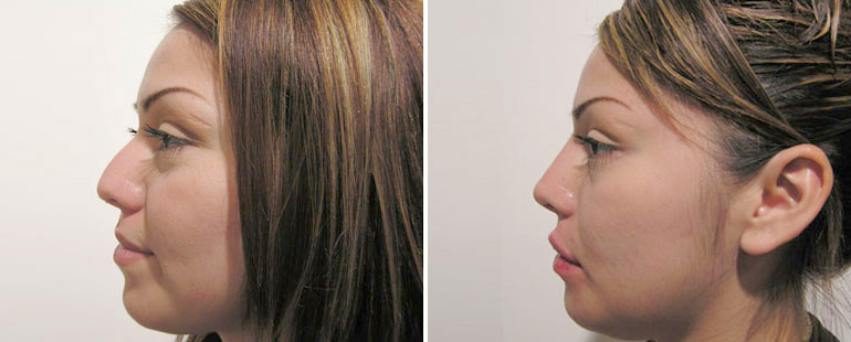 nose job