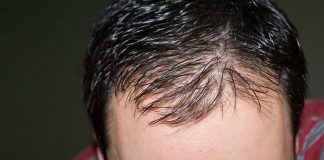 baldness